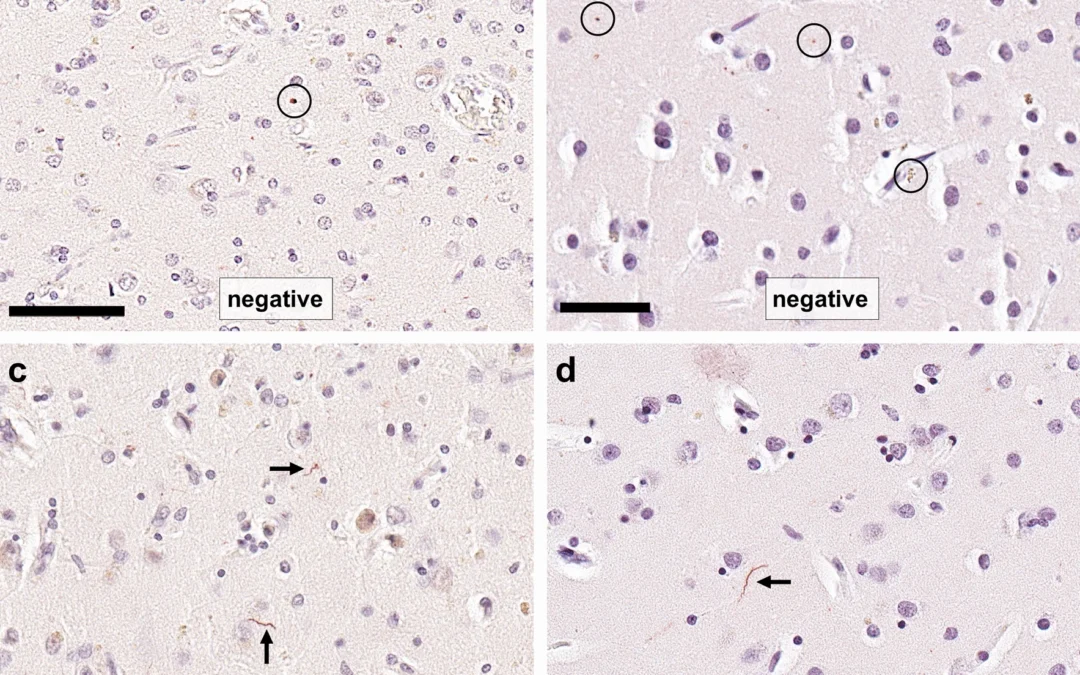 Neuropathological consensus criteria for the evaluation of Lewy pathology in post-mortem brains: a multi-centre study