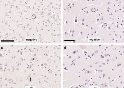 Neuropathological consensus criteria for the evaluation of Lewy pathology in post-mortem brains: a multi-centre study