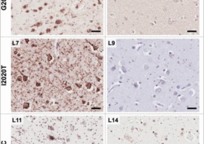 Widespread distribution of α-synuclein oligomers in LRRK2-related Parkinson’s disease