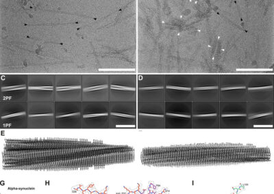 A novel alpha-synuclein G14R missense variant is associated with atypical neuropathological features
